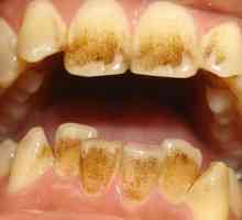 Петна от кафе на зъби: причини и методи на елиминиране