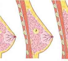 Аденом на гърдата: симптоми, методи на лечение