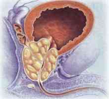 Какво представлява простатната аденома? Белодробна хиперплазия на простатата