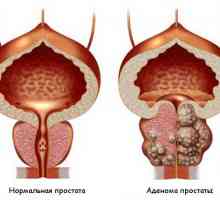 Аденом на простатата: симптоми, лечение, операция