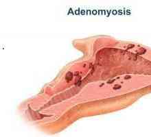 Аденомиоза на матката - какво е това? Аденомиоза на матката: лечение с народни средства, прегледи
