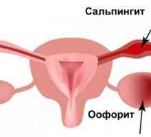 Adnexitis: симптоми и лечение при жени