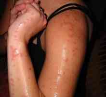 Алергия към ухапвания от комари - симптоми и лечение