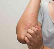 Алергии към кожата: възможни причини, симптоми и характеристики на лечението