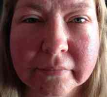 Алергия към лицето на слънцето: снимки, симптоми, лечение