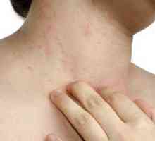 Алергия към шията: причини при възрастни и деца