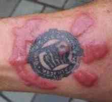 Алергия към татуировки: симптоми, възможни причини и характеристики на лечението
