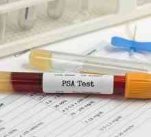 PSA анализ с простатит: нормата, характеристиките на подготовката и препоръките