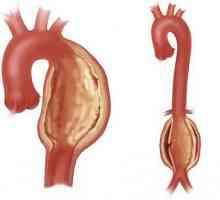 Аневризма на аортата на сърцето - какво е това? Аневризма на аортата: причини, симптоми, лечение