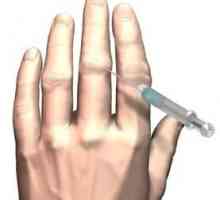 Артрит на пръстите: лечение, причини, симптоми