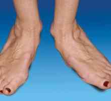 Артрит на краката: лечение и причините за появата