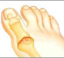 Артрит на крака: сортове, профилактика