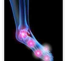 Артрит на ставите на крака: причини, признаци и лечение