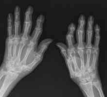 Артроза на ръцете: лечение, симптоми и причини