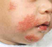 Атопичен дерматит при дете: лечение и симптоми