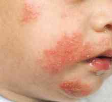 Атопичен дерматит при дете: причини, симптоми, лечение