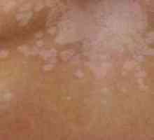 Бели петна по кожата след слънчево изгаряне: лечение, снимка