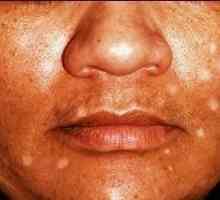 Белите петна по лицето могат да бъдат знак за витилиго