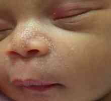 Бели точки на носа на новороденото. Защо новороденото има бели точки на носа? Кога преминават…