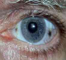 Бяло катерично око. Бързо избелване на очните протеини