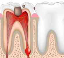 Болезнено ли е да премахнете нервите от зъба? Защо зъб се нуждае от нерв? Как да премахнете нервите…