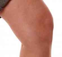 Какво се характеризира с лечението на синовита на колянната става?