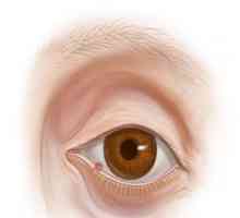 Какво е лечението на ечемика на окото? Предотвратяване на ечемика