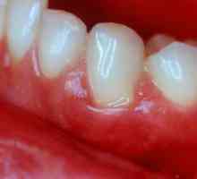 Какво е лечението на заболяването на венците? Полезни съвети