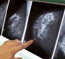 Каква е разликата между мамография и ултразвук на млечните жлези? Какво е по-информативно и…