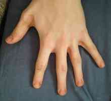Cheshutya ръцете между пръстите: причините и лечението