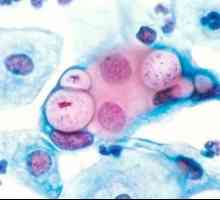 Chlamydia trachomatis. Какво е това и какви заболявания причинява?