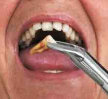 Какво да направите след изваждането на зъбите - начини да спрете кръвта и да излекувате раната