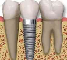 Какво препоръчват зъболекарите, когато има нужда от поставяне на зъби?