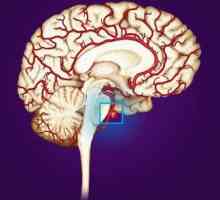 Какво представлява аневризма на мозъчните съдове? Аневризъм на мозъка: симптоми, диагноза