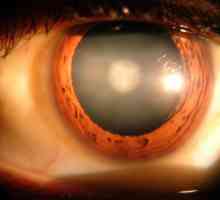 Какво е мързеливо око и за какво е опасно?