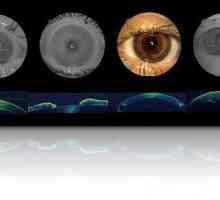 Какво представлява оптичната кохерентна томография на окото?