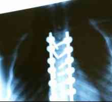 Какво представлява рентгеновото изследване на гръбначния стълб?
