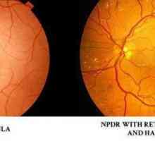 Какво представлява ретинопатията при пациенти с диабет? Ретинопатия при захарен диабет: симптоми,…