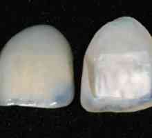 Какво представляват фурните за зъби? Облицовка за зъби - фасети