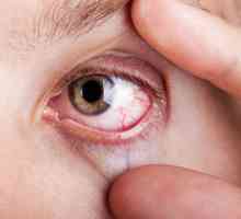 Демодектично око: причини, симптоми и характеристики на лечението