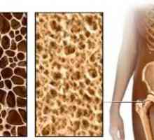 Денситометрията на костите и остеопорозата е още един шанс да се научи предварително за заболяването
