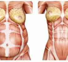 Диастаза на ректусите на коремните мускули след раждане: признаци, лечение, снимка