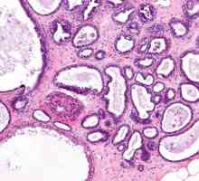 Дифузна фибро-аденоматоза на млечните жлези: причини и лечение