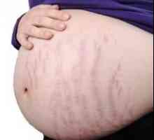 Има ли идеално средство за лечение на стрии по време на бременност?
