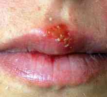 Има ли лекарство за херпес на устната лига, която може да се отърве от себе си от това заболяване?