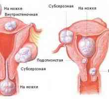 Фиброиди на матката: първите признаци и лечение
