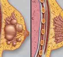 Фиброза на млечните жлези: диагноза и лечение
