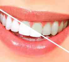 Флуорирането на зъбите - какво е това? Как се извършва процедурата на дълбока флуоризация на зъбите?