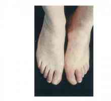 Гангреновите крака: Причини, симптоми и лечение