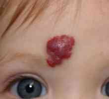Хемангиом на лицето: причини и лечение. Хемангиом на лицето при възрастни и деца